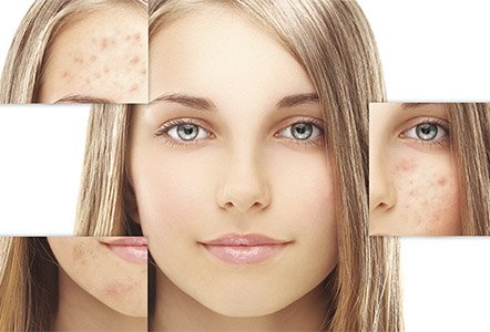 Fatal Mistakes in Acne Laser Treatment