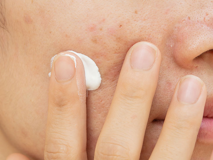 Understand The Best Benefits Of Scar Cream Treatment