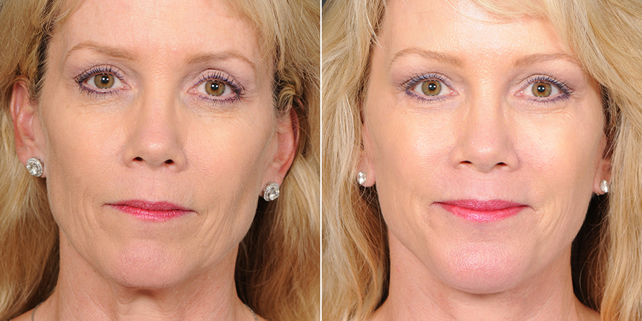 The blepharoplasty Santa Barbara will be the best option